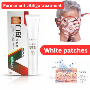 Vitiligo Support Cream – For White Patches / Pigmentation Care
