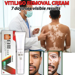 Vitiligo Support Cream – For White Patches / Pigmentation Care